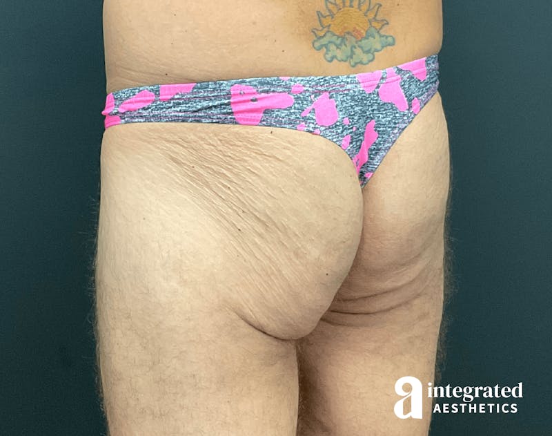 Butt Lift Before & After Gallery - Patient 133212535 - Image 3