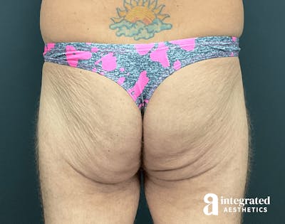 Butt Lift Before & After Gallery - Patient 133212535 - Image 1