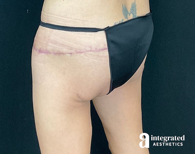 Butt Lift Before & After Gallery - Patient 133212537 - Image 4