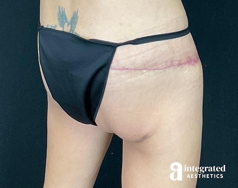 Butt Lift Before & After Gallery - Patient 133212537 - Image 6