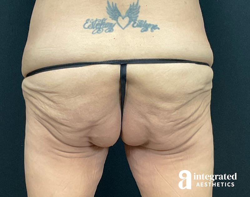 Butt Lift Before & After Gallery - Patient 133212537 - Image 1