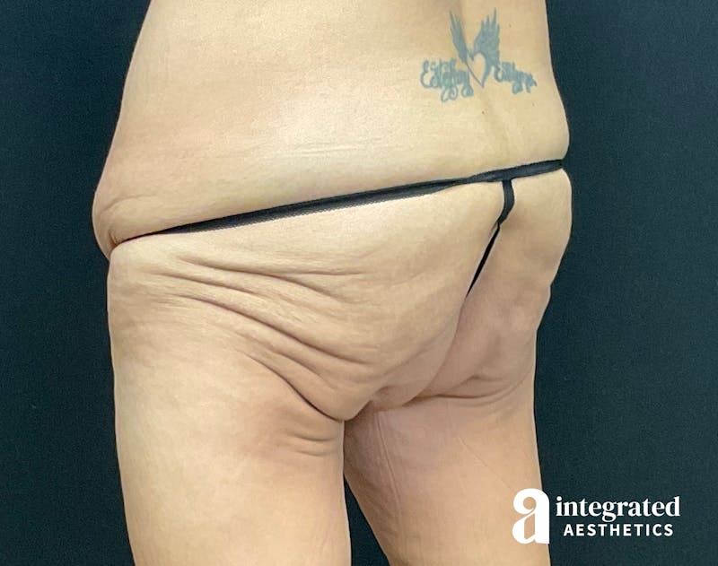Butt Lift Before & After Gallery - Patient 133212537 - Image 3