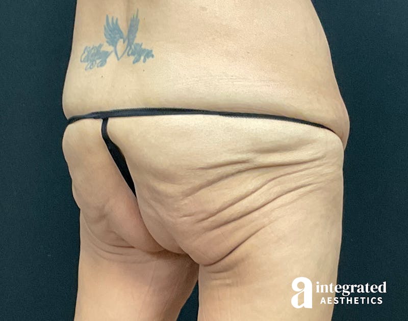 Butt Lift Before & After Gallery - Patient 133212537 - Image 5