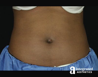 CoolSculpting Before & After Gallery - Patient 133212648 - Image 1
