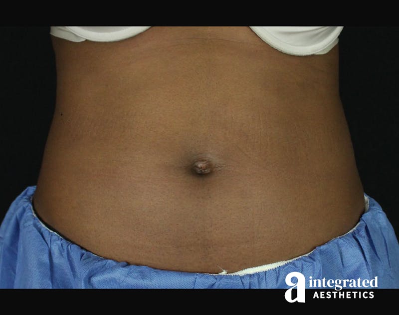 CoolSculpting Before & After Gallery - Patient 133212648 - Image 1