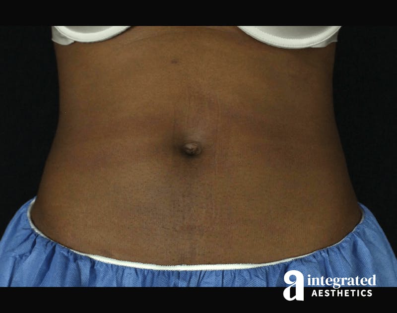 CoolSculpting Before & After Gallery - Patient 133212648 - Image 2