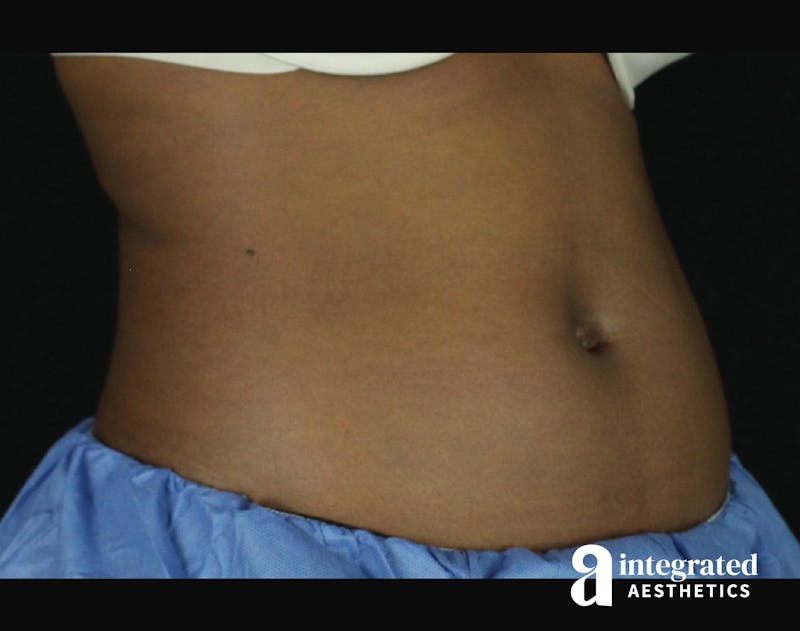 CoolSculpting Before & After Gallery - Patient 133212648 - Image 3