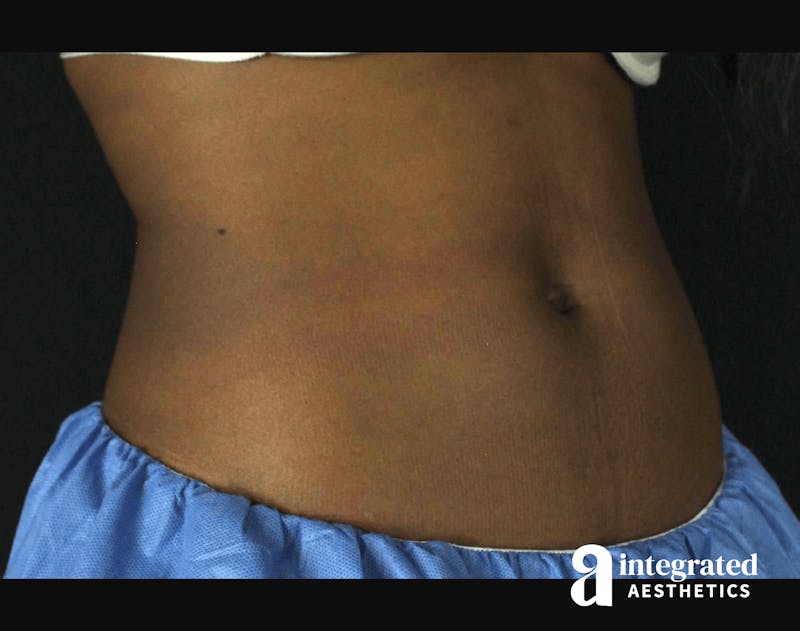 CoolSculpting Before & After Gallery - Patient 133212648 - Image 4