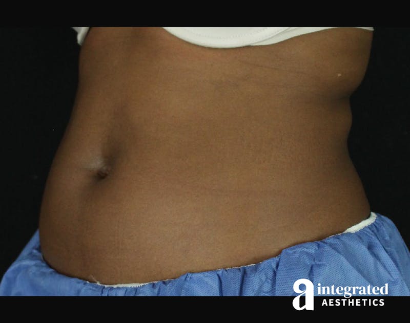 CoolSculpting Before & After Gallery - Patient 133212648 - Image 5