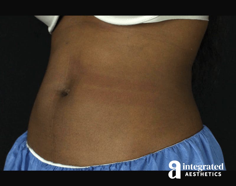 CoolSculpting Before & After Gallery - Patient 133212648 - Image 6