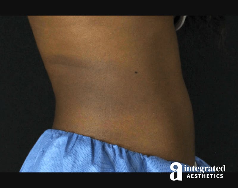 CoolSculpting Before & After Gallery - Patient 133212648 - Image 8