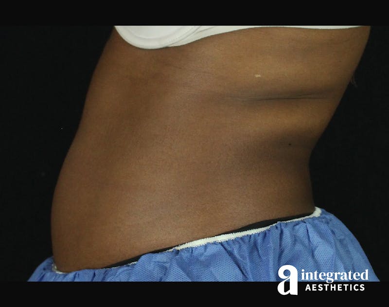CoolSculpting Before & After Gallery - Patient 133212648 - Image 9