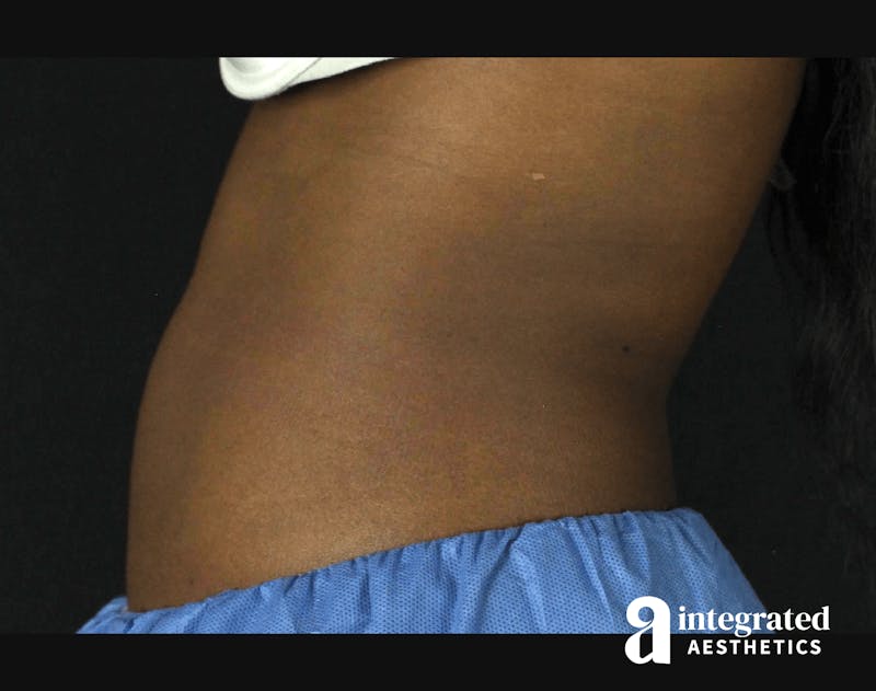 CoolSculpting Before & After Gallery - Patient 133212648 - Image 10