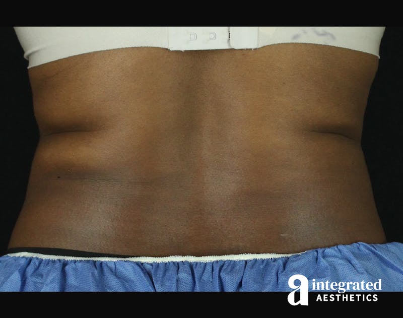 CoolSculpting Before & After Gallery - Patient 133212648 - Image 11