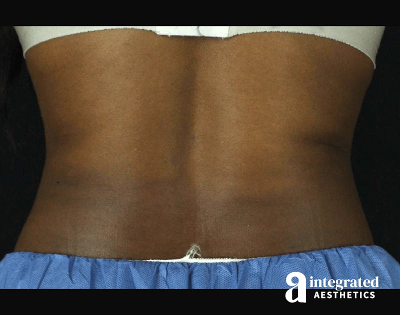 CoolSculpting Before & After Gallery - Patient 133212648 - Image 12