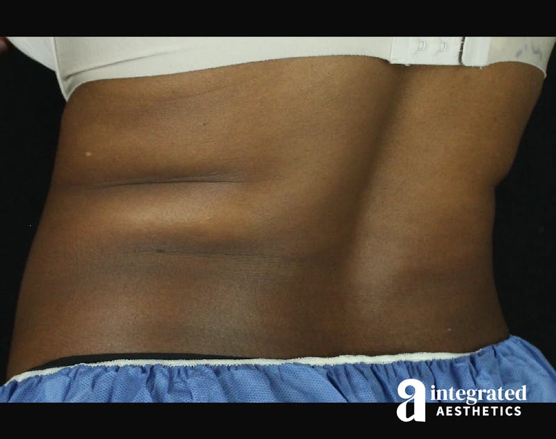 CoolSculpting Before & After Gallery - Patient 133212648 - Image 13