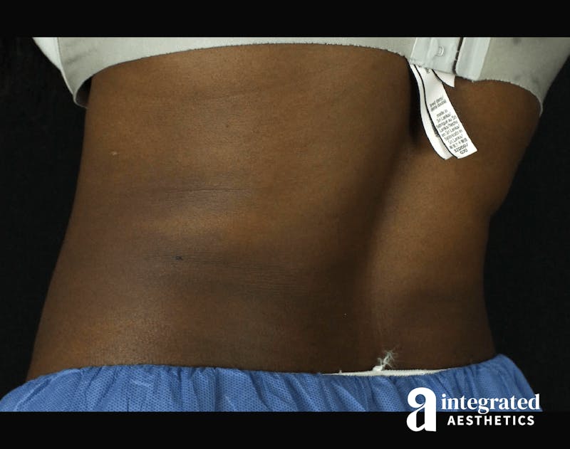 CoolSculpting Before & After Gallery - Patient 133212648 - Image 14