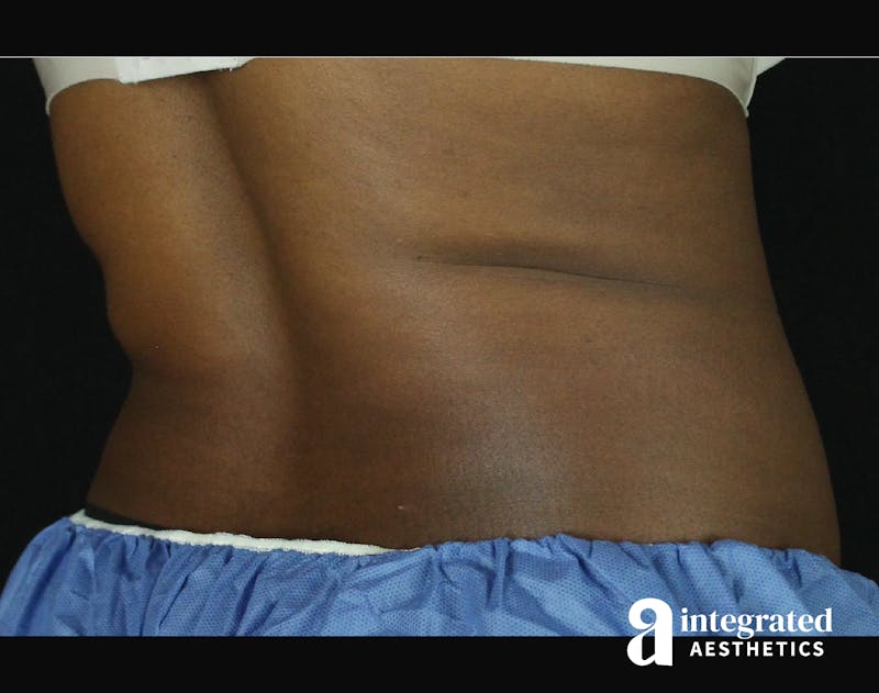 CoolSculpting Before & After Gallery - Patient 133212648 - Image 15