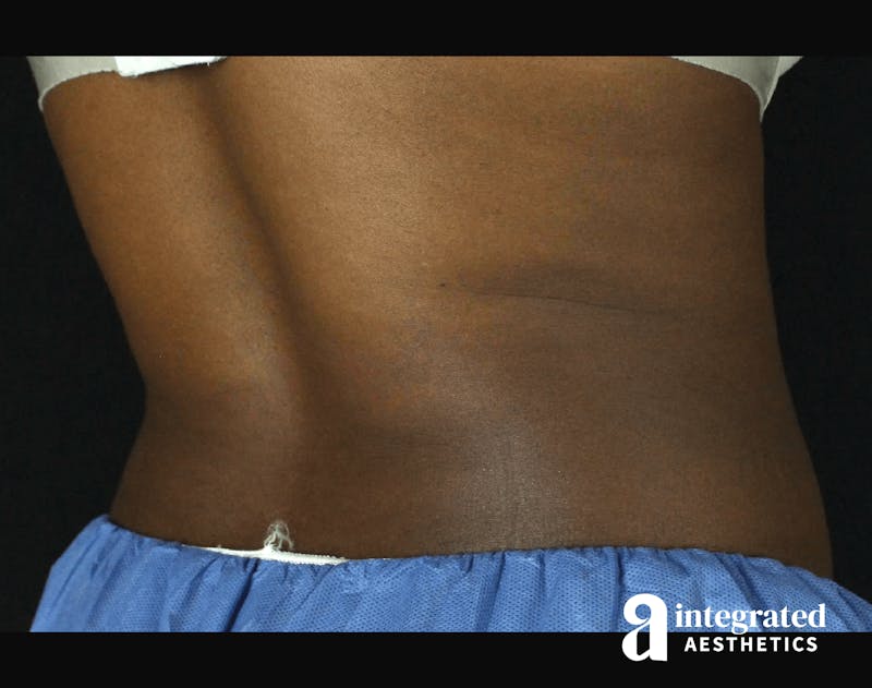 CoolSculpting Before & After Gallery - Patient 133212648 - Image 16