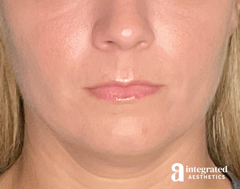 Lip Filler Before & After Gallery - Patient 157266203 - Image 1