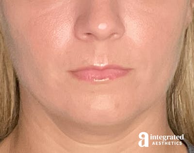Lip Filler Before & After Gallery - Patient 157266203 - Image 1