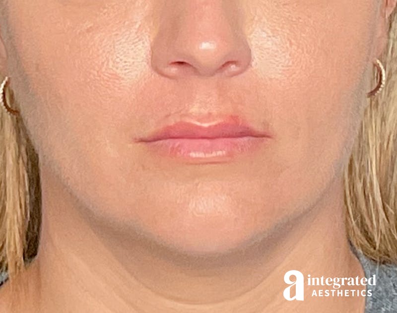 Lip Filler Before & After Gallery - Patient 157266203 - Image 2