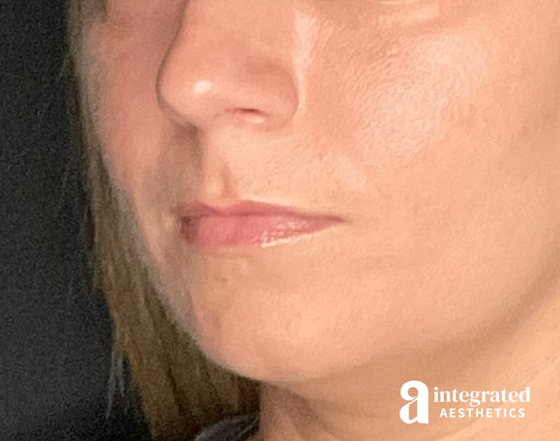 Dermal Fillers Before & After Gallery - Patient 133212623 - Image 3