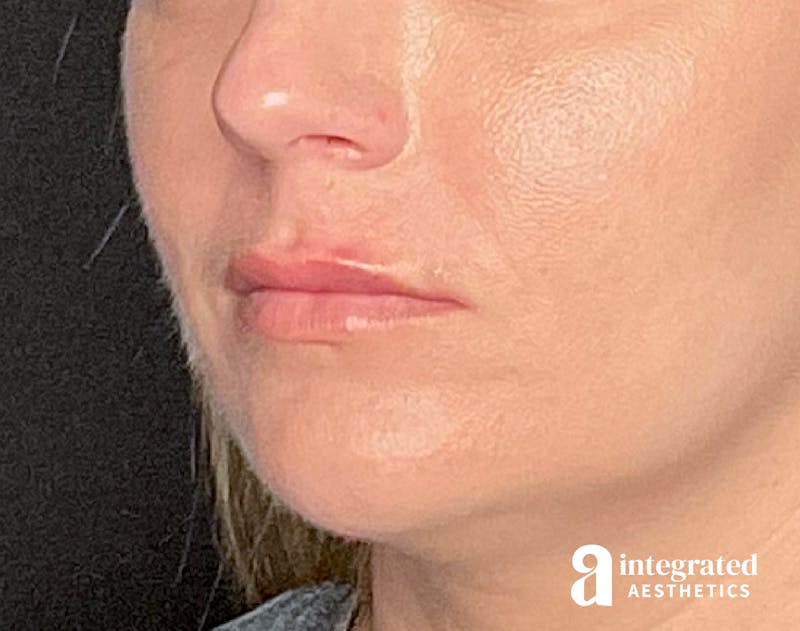 Dermal Fillers Before & After Gallery - Patient 133212623 - Image 4