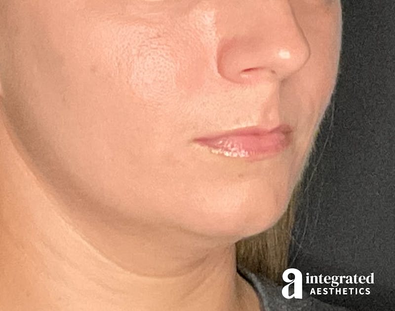 Lip Filler Before & After Gallery - Patient 157266203 - Image 5