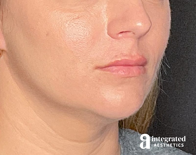 Dermal Fillers Before & After Gallery - Patient 133212623 - Image 6