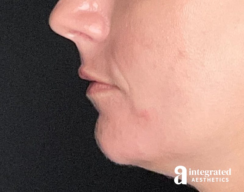 Lip Filler Before & After Gallery - Patient 157266203 - Image 7