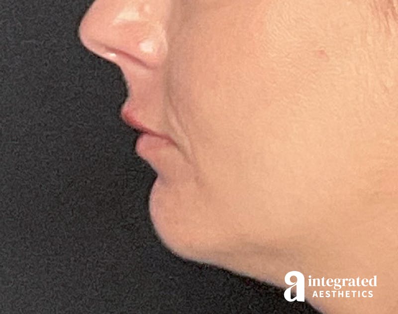 Dermal Fillers Before & After Gallery - Patient 133212623 - Image 8