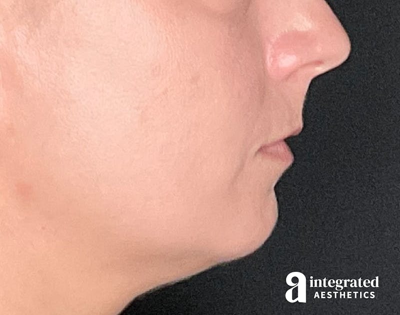 Lip Filler Before & After Gallery - Patient 157266203 - Image 9