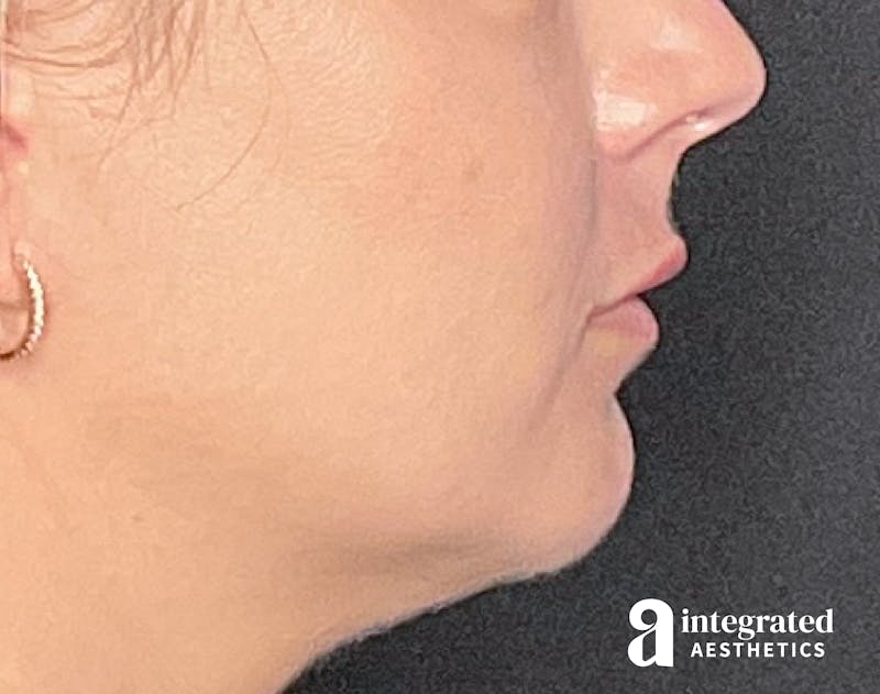 Lip Filler Before & After Gallery - Patient 157266203 - Image 10