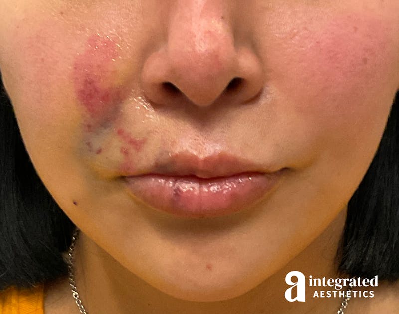 Resolved Aesthetic Complications Before & After Gallery - Patient 139510875 - Image 1