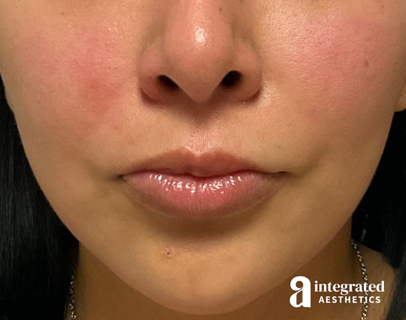 Resolved Aesthetic Complications Before & After Gallery - Patient 139510875 - Image 2