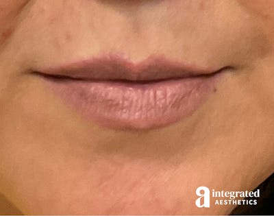 Dermal Fillers Before & After Gallery - Patient 133212621 - Image 1