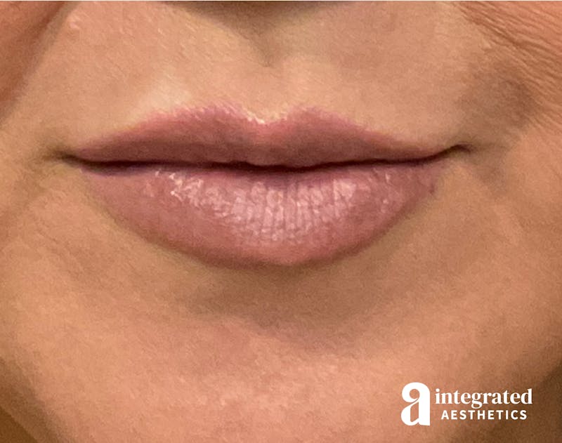 Dermal Fillers Before & After Gallery - Patient 133212621 - Image 2