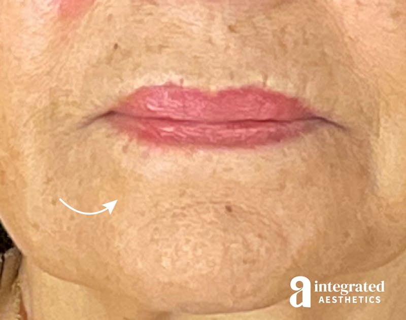 Dermal Fillers Before & After Gallery - Patient 133212620 - Image 1