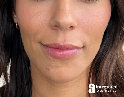 Dermal Fillers Before & After Gallery - Patient 133212646 - Image 2