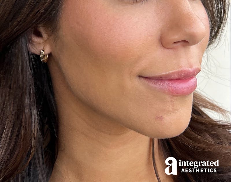 Dermal Fillers Before & After Gallery - Patient 133212646 - Image 4