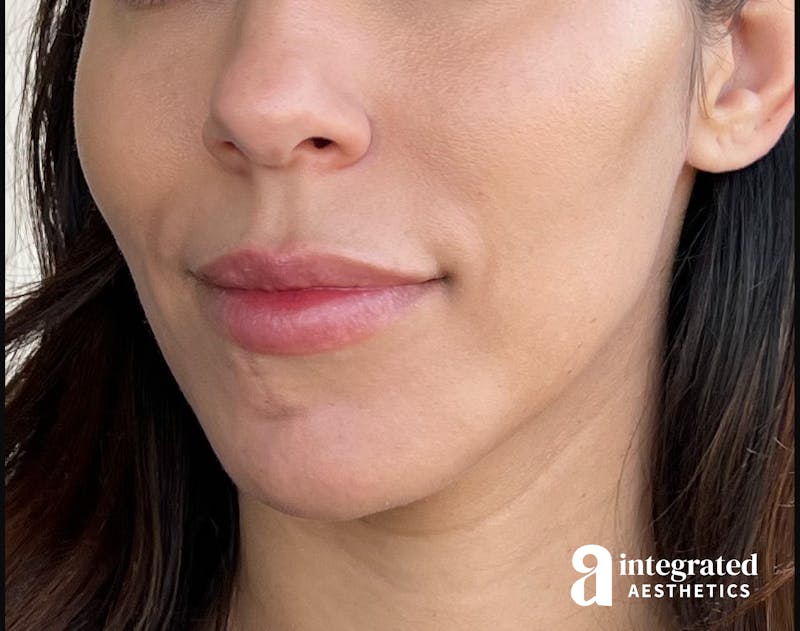 Dermal Fillers Before & After Gallery - Patient 133212646 - Image 7