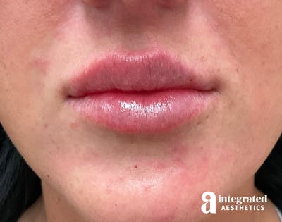 Dermal Fillers Before & After Gallery - Patient 133212645 - Image 2