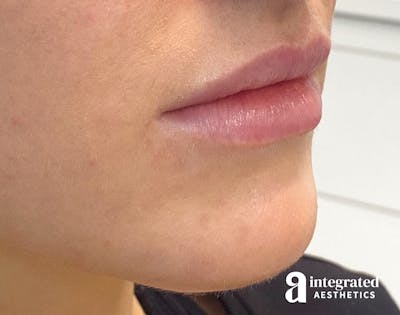 Lip Filler Before & After Gallery - Patient 157175662 - Image 1