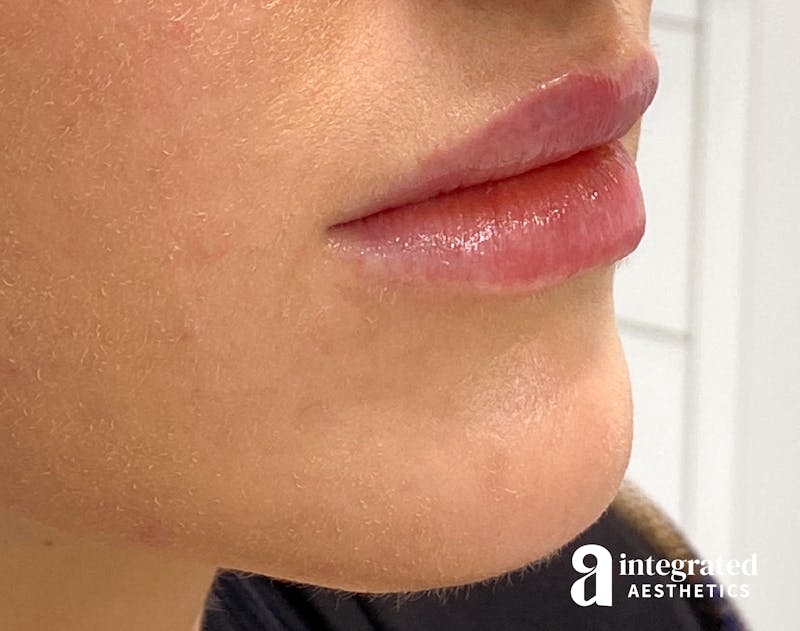 Dermal Fillers Before & After Gallery - Patient 133212644 - Image 2