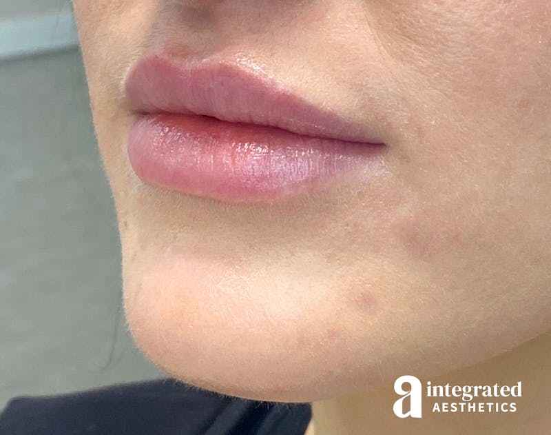 Lip Filler Before & After Gallery - Patient 157175662 - Image 3