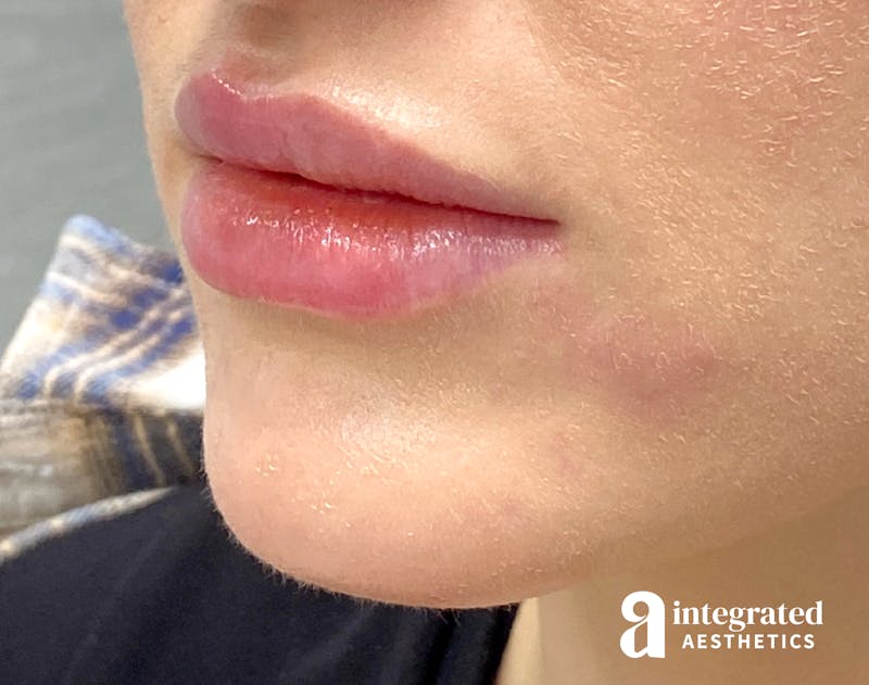 Lip Filler Before & After Gallery - Patient 157175662 - Image 4