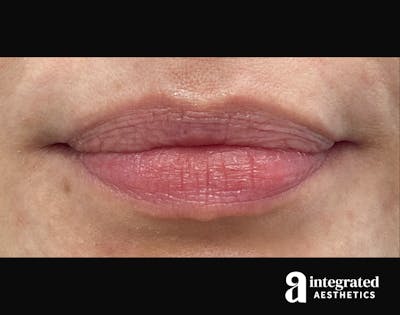 Dermal Fillers Before & After Gallery - Patient 133212657 - Image 1