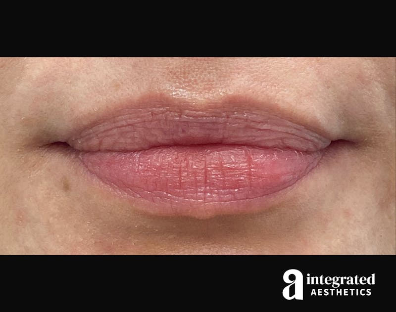 Dermal Fillers Before & After Gallery - Patient 133212657 - Image 1