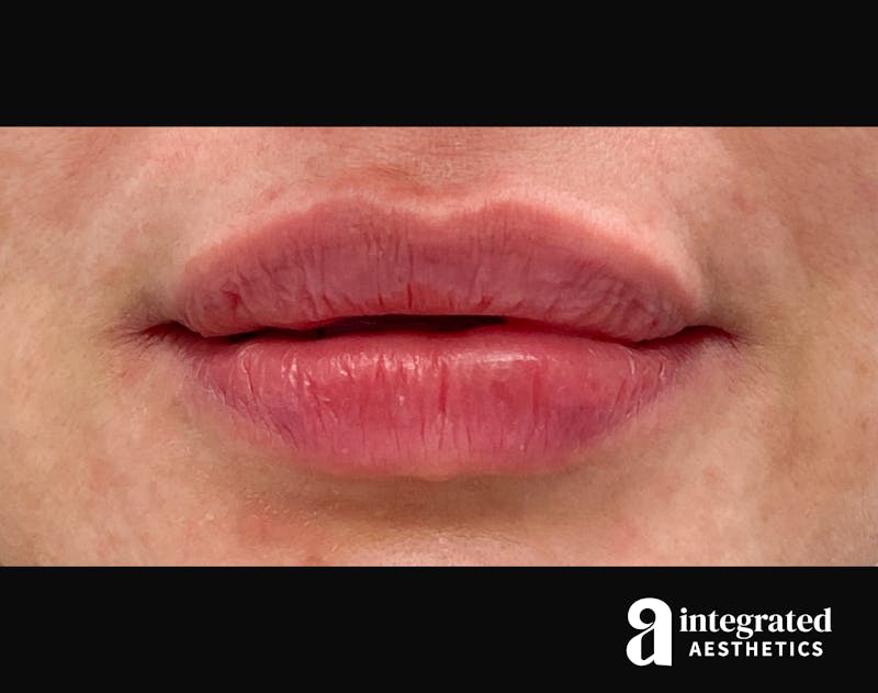 Dermal Fillers Before & After Gallery - Patient 133212657 - Image 2
